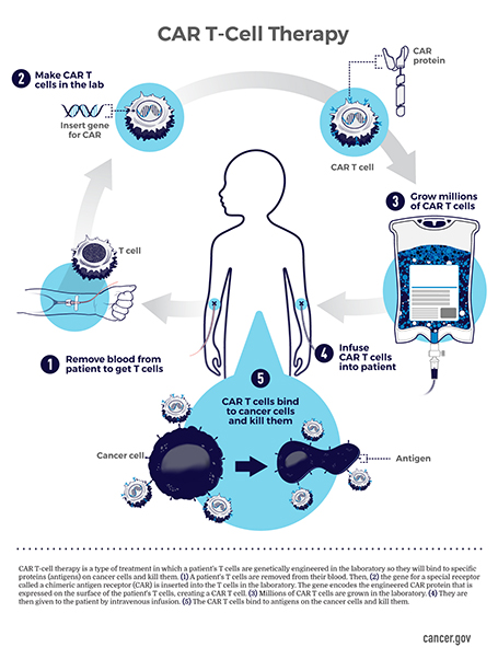 This diagram depicts how a patient’s own T cells are transformed into chimeric antigen receptor (CAR) T cells (one of the types of treatments the Surgery Branch works on) in the laboratory and infused back into a patient to kill cancer cells. (Image by the National Cancer Institute.)