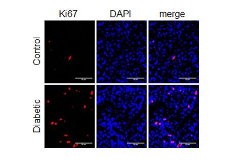 Image of stained cells showing faster tumor growth in diabetic mice