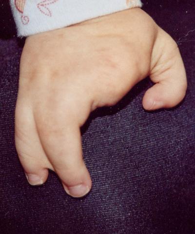 split hand/foot malformation
