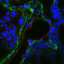 Immunofluorescence image of TEM8 in TNBC cells
